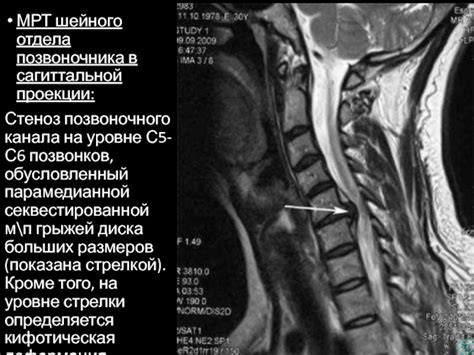 Риск развития межпозвоночной грыжи в шейном отделе