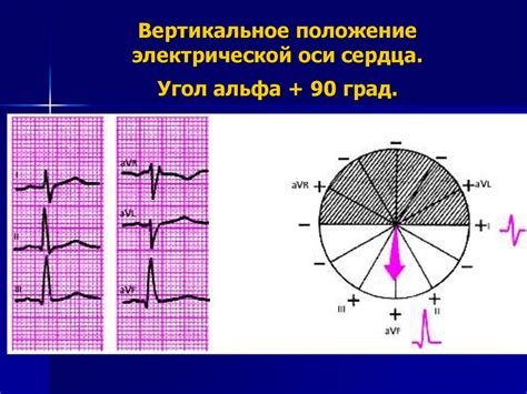 Ритм синусовый: вертикальное положение электрической оси сердца