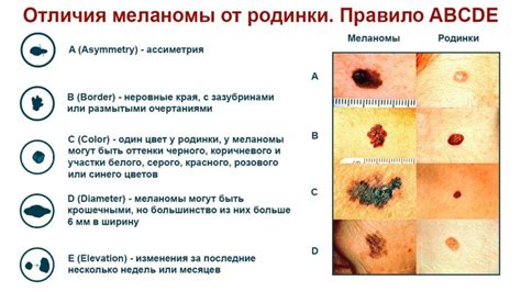 Родимые пятна: опасность и значение