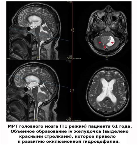 Роль МРТ в диагностике гидроцефалии у взрослых