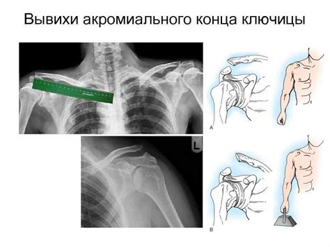 Роль акромиального конца ключицы в обеспечении движений руки и плеча