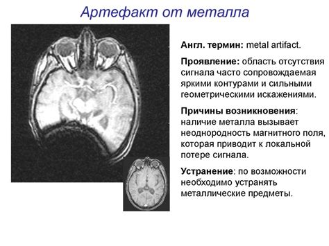 Роль артефактов при МРТ