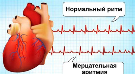 Роль гликозидов сердца при аритмии сердца