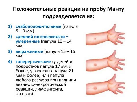 Роль манту в детском здоровье