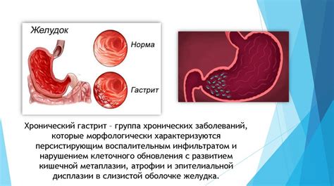 Роль питания в лечении гастрита