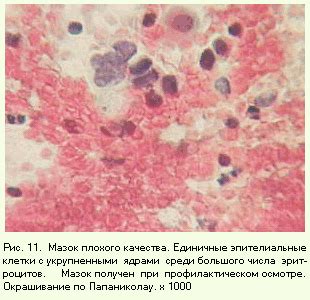 Роль питания и отсутствие метаплазированного эпителия