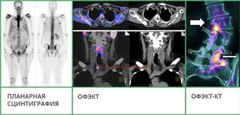 Роль радиофармпрепарата в сцинтиграфии скелета