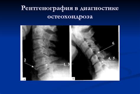 Роль рентгенологии в диагностике остеохондроза