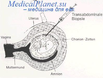 Роль ретромаммарного пространства в амниоцентезе