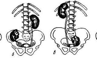 Ротация почки у ребенка