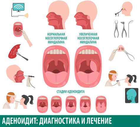 Рыхлые аденоиды: симптомы и диагностика