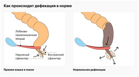 Самопроизвольная дефекация