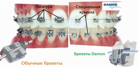 Саморегулирующие брекеты: технология и принцип действия