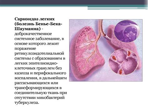 Саркоидоз легких: суть и обнаружение