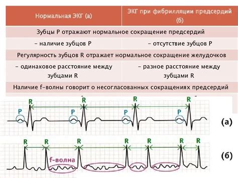 Связь низковольтажной ЭКГ с нарушениями сердечной активности