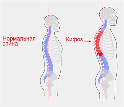 Сглаженный кифоз и его признаки