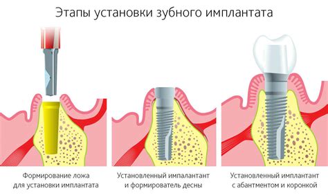 Сепарация зубов: основные аспекты и этапы процедуры