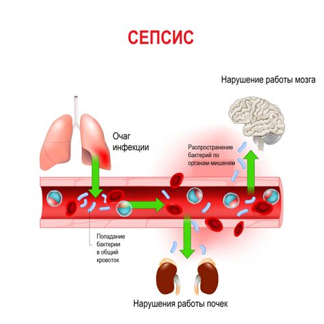 Сепсис: способы лечения и реабилитации