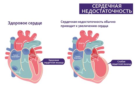 Сердечная недостаточность: формы и симптомы