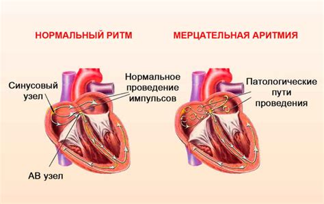 Сердечные аритмии и возможные заболевания