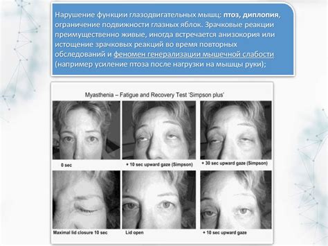 Серопозитивная миастения