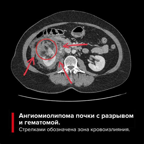 Симптомы ангиомиолипомы правой почки