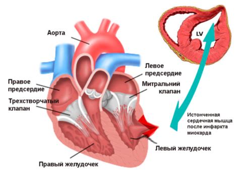 Симптомы аневризмы левого желудочка сердца