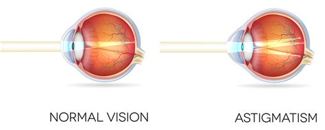 Симптомы астигматизма и почему важна его диагностика