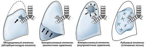 Симптомы ателектаза легких