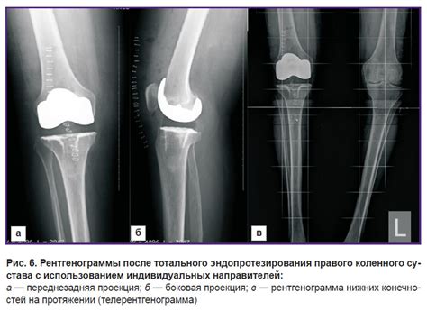 Симптомы варусной деформации коленного сустава