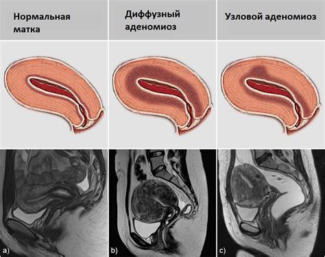 Симптомы внутреннего аденомиоза матки