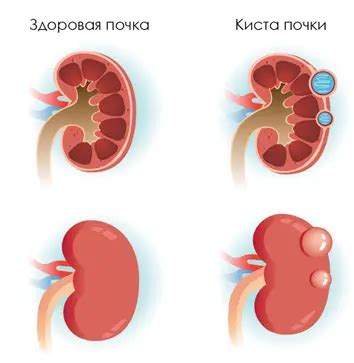 Симптомы внутрисинусной кисты правой почки