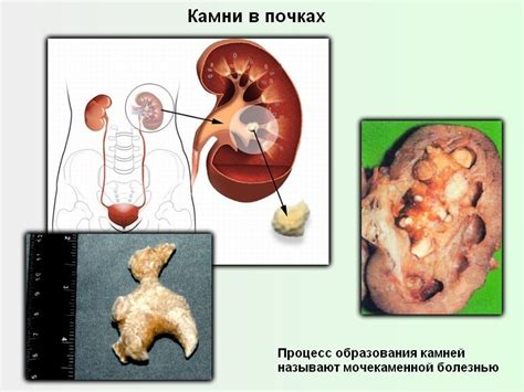 Симптомы водянки на почке