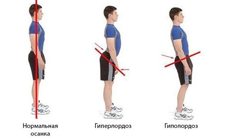 Симптомы выпрямления поясничного лордоза