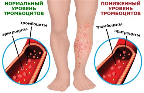 Симптомы высокого уровня тромбоцитов