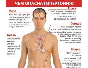 Симптомы гипертонии, которые необходимо узнать