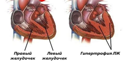 Симптомы гипертрофии правого желудочка