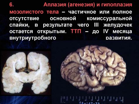 Симптомы гипогенезии мозолистого тела