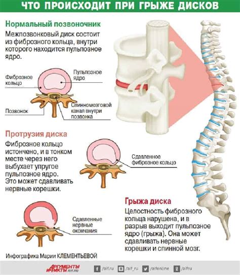 Симптомы гипогидратации межпозвоночных дисков