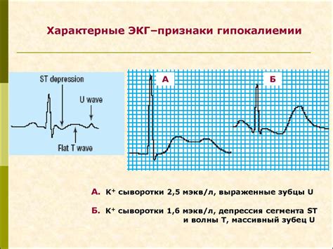 Симптомы гипокалиемии и их возможные последствия