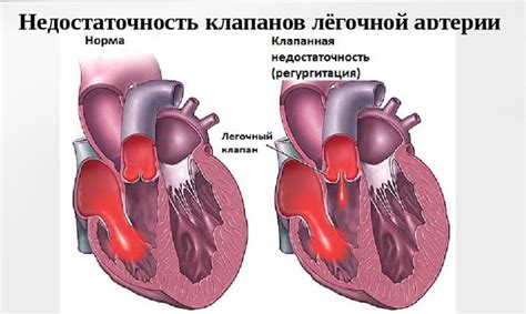 Симптомы гипоэволютивного сердца у взрослых