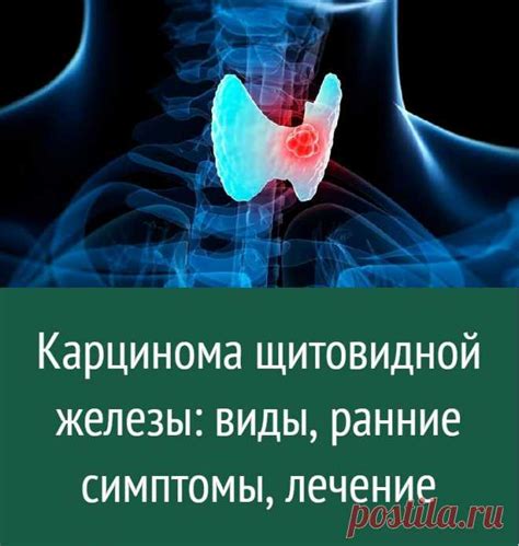 Симптомы гипоэхогенного аваскулярного образования щитовидной железы