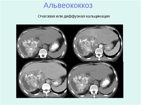 Симптомы гипоэхогенного неоднородного образования в печени