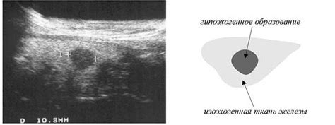 Симптомы гипоэхогенного образования