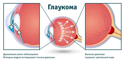 Симптомы глаукомы