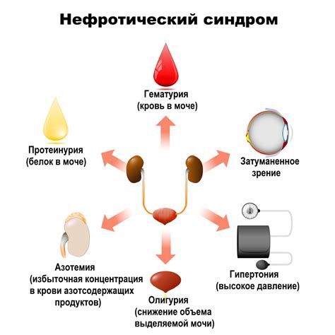 Симптомы гломерулонефрита