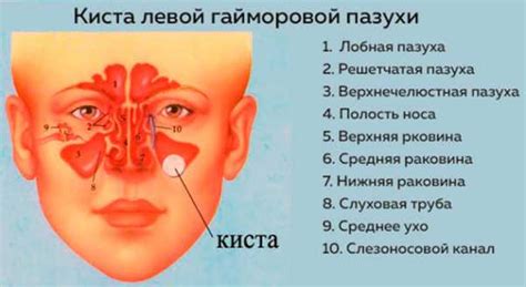 Симптомы гранулемы в пазухе носа