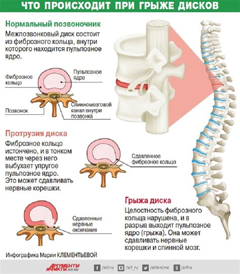 Симптомы грыжи