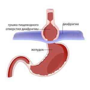 Симптомы грыжи пищеводного отверстия диафрагмы