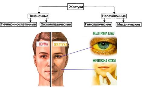 Симптомы желтухи у детей